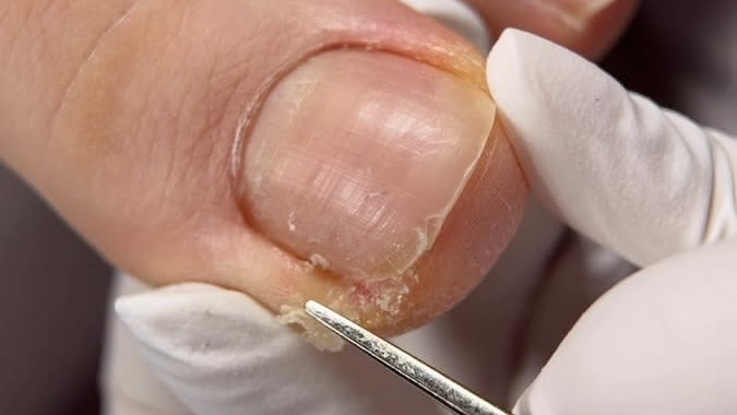 Ingrown 