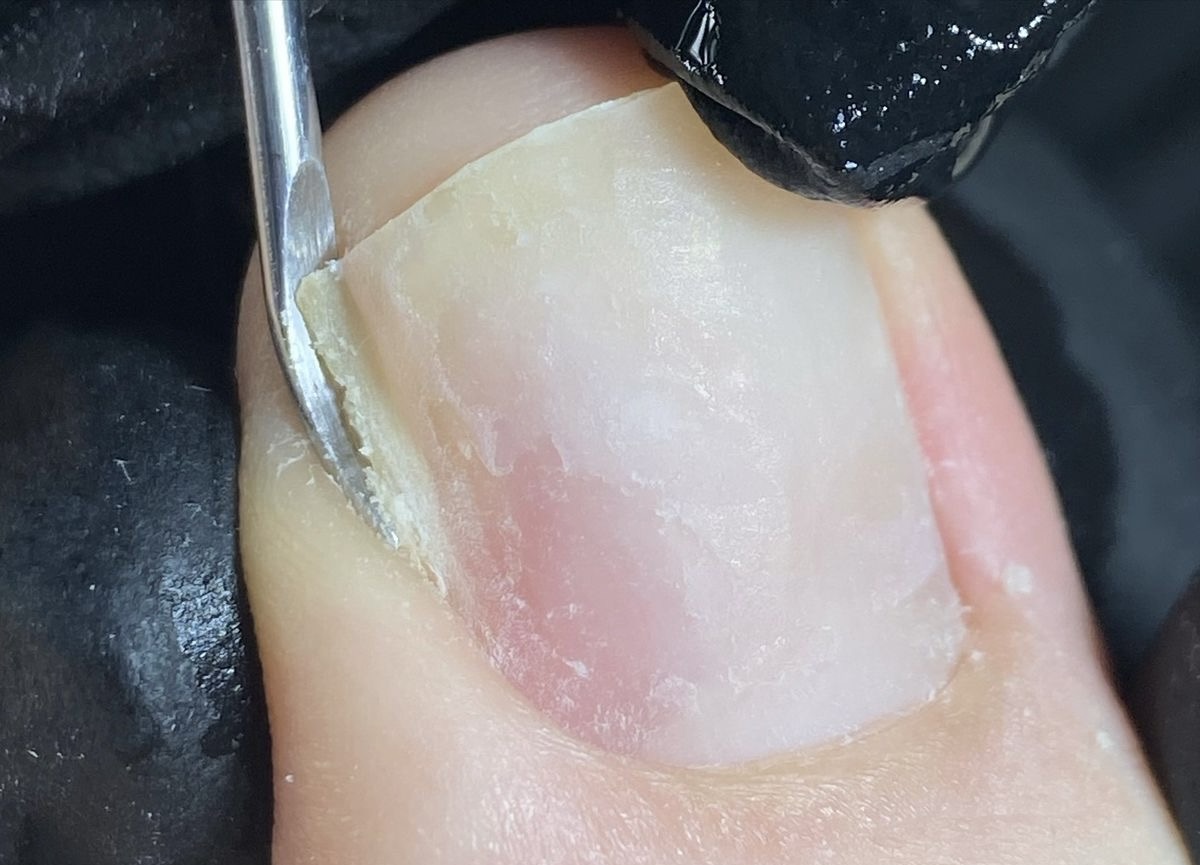 Ingrown  Image 3